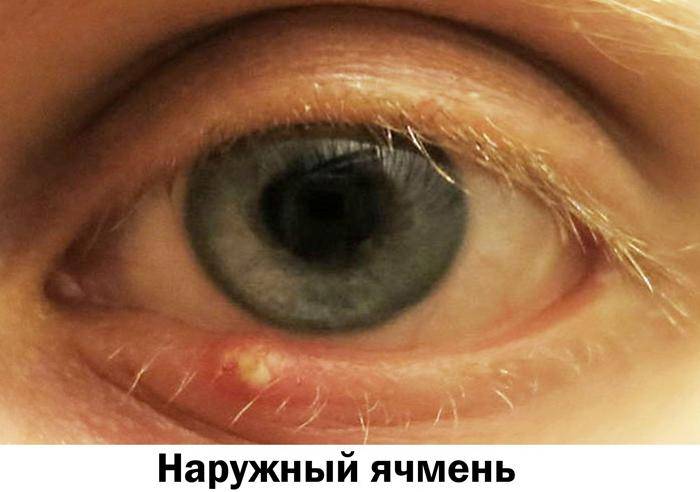 Ячмень на глазу при беременности – особенности лечения oculistic.ru
ячмень на глазу при беременности – особенности лечения