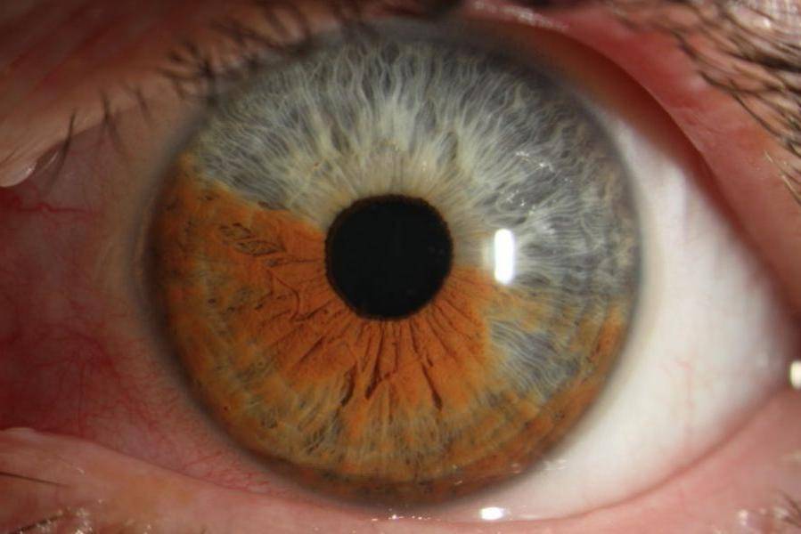 Афакия глаза: причины, симптомы, диагностика и лечение