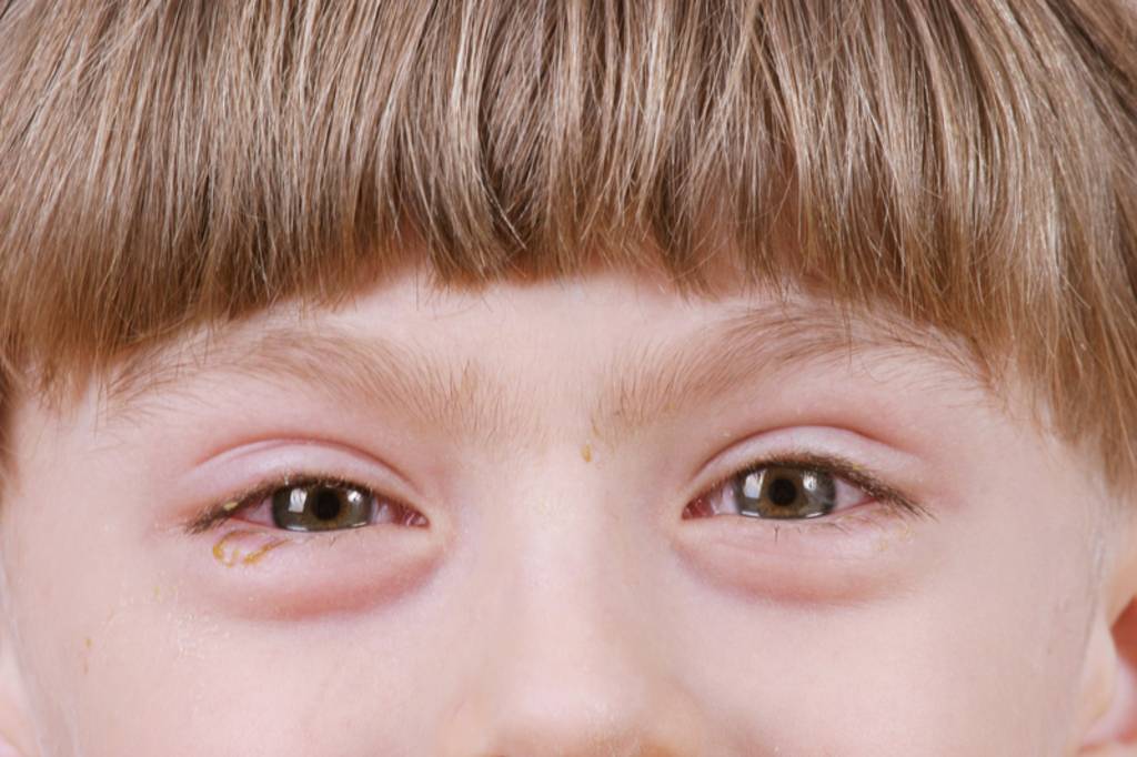 Слезится один глаз у ребенка - причины, возможные заболевания.