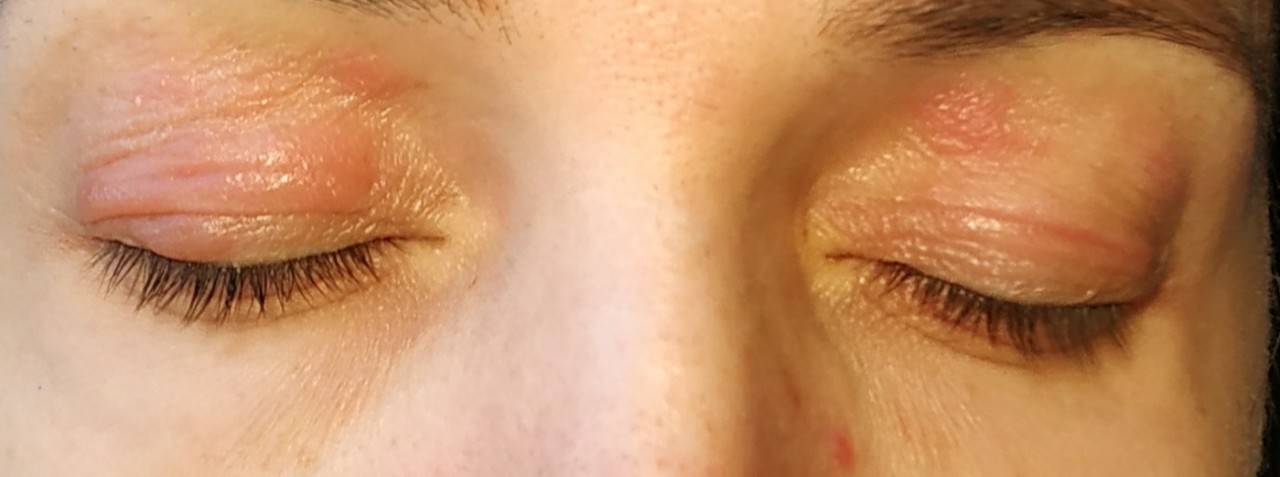 Почему чешутся глаза: причины и лечение - "здоровое око"