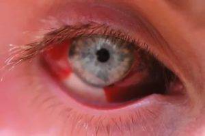 Как снять покраснение глаз: 10 работающих домашних средств - здоровье с headinsider