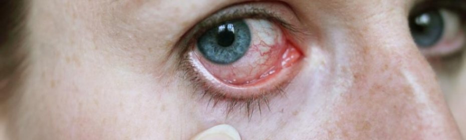 Воспаление глаза: чем лечить, симптомы, диагноз, как снять отёк мазью, лечение у взрослых в домашних условиях народными средствами