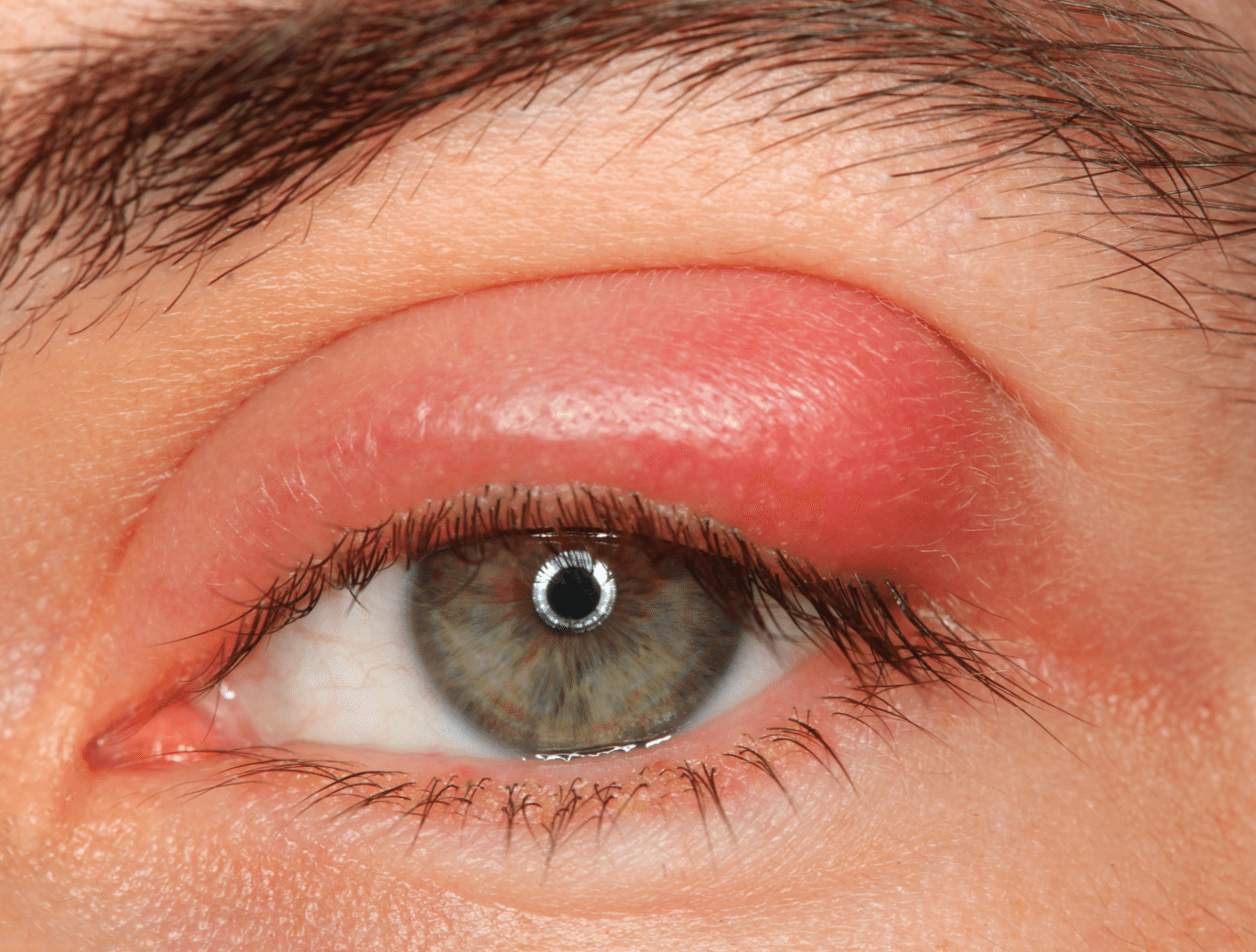Герпес на глазах (офтальмогерпес): фото, лечение