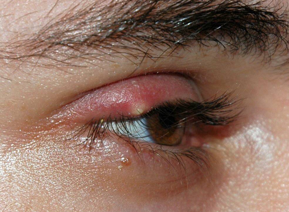 Офтальмогерпес или герпес на глазах: как проявляется и правильно лечится?