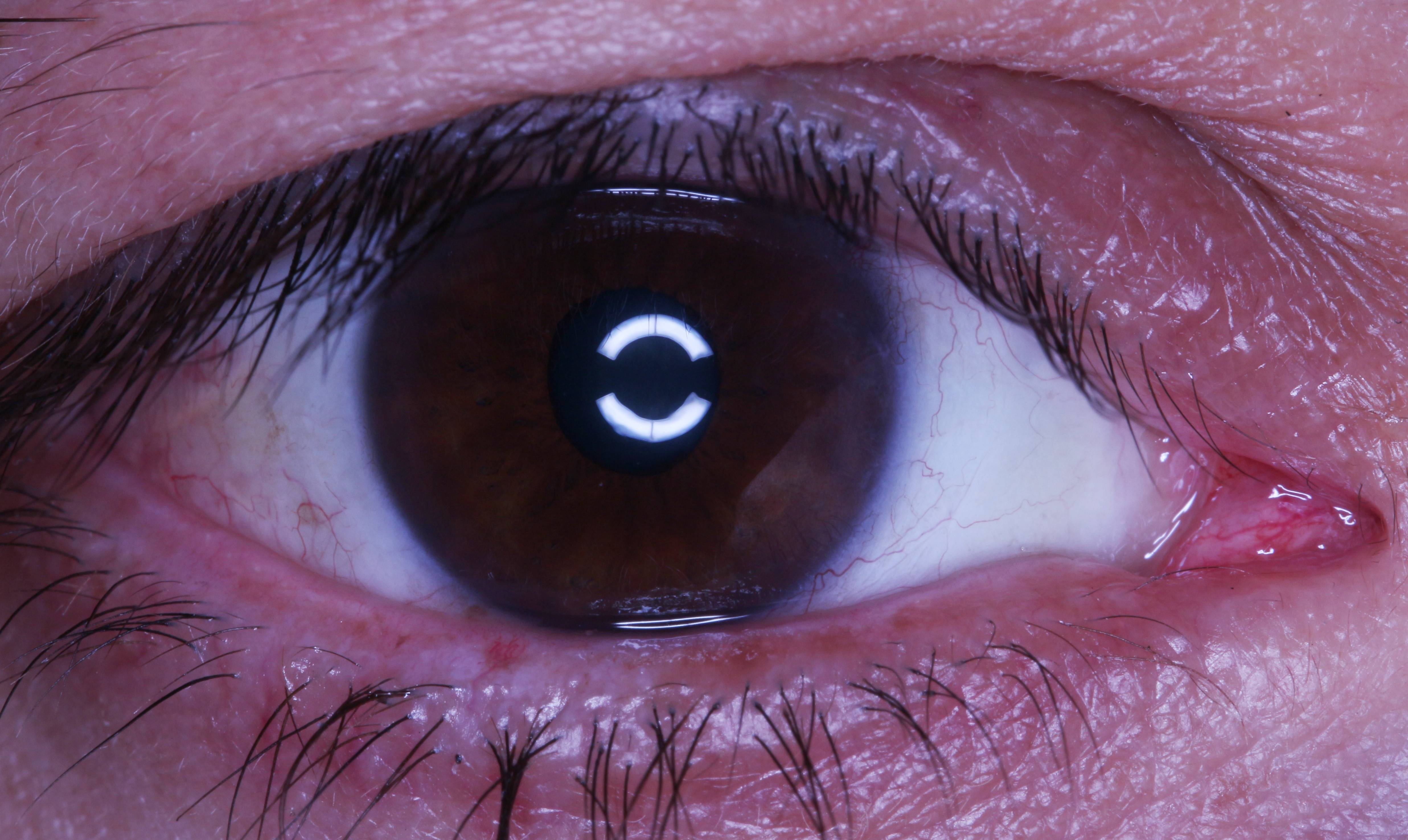Птеригиум: заболевание глаз, нарост на роговице, его причины и способы иссечения птеригия