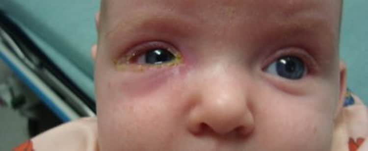 Слезится глаз у новорожденного: причины и лечение