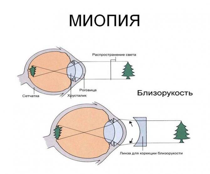 Как восстановить зрение при близорукости - простые методики