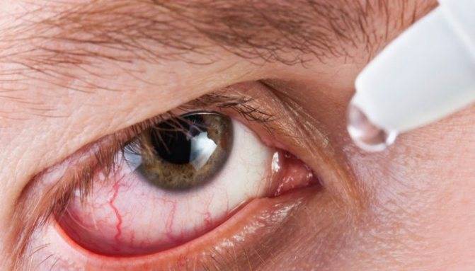 Воспаление глаза: основные причины и лечение oculistic.ru
воспаление глаза: основные причины и лечение