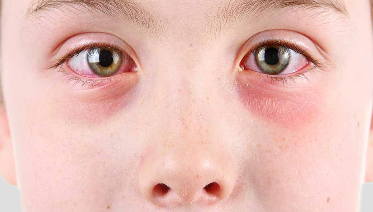 Аллергический конъюнктивит у детей: симптомы и лечение