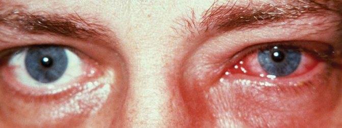 Офтальмогерпес и герпетический кератит: как сохранить зрение?