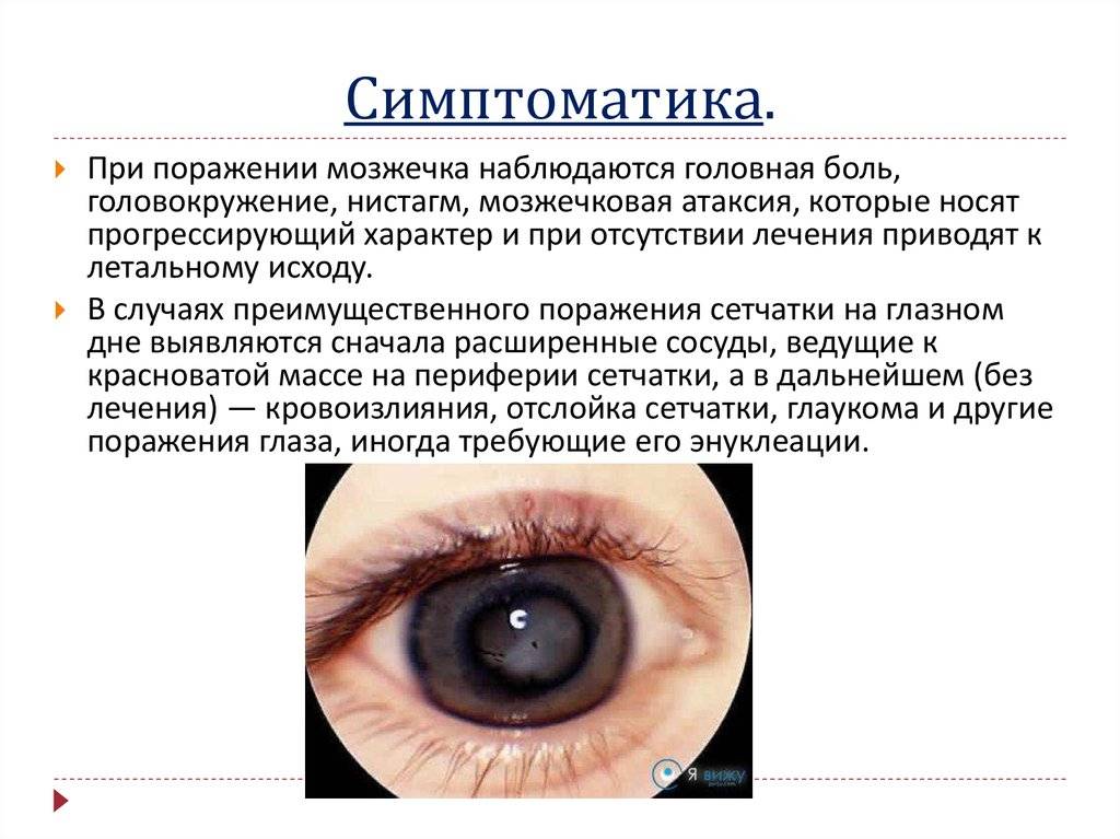 Нистагм код по мкб 10: симптомы, причины и лечение заболевания. — глаза эксперт