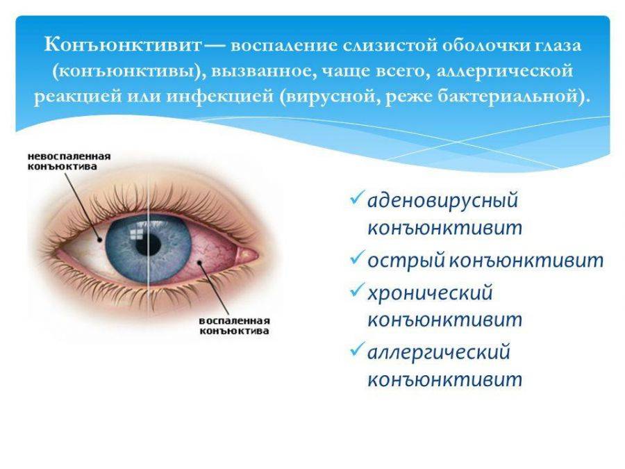 Вирусный конъюнктивит у взрослых: причины, симптомы, лечение, препараты для терапии острой энтеровирусной инфекции глаз
