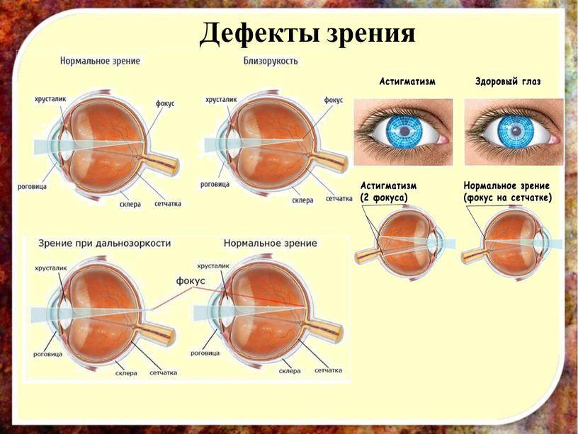 Причины резкого ухудшения зрения
