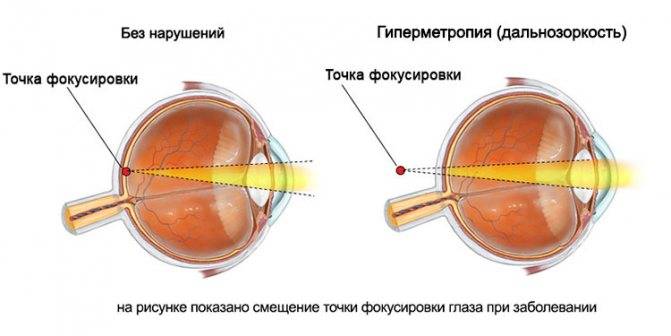 Дальнозоркость у детей и возрастная дальнозоркость: лечение, коррекция зрения