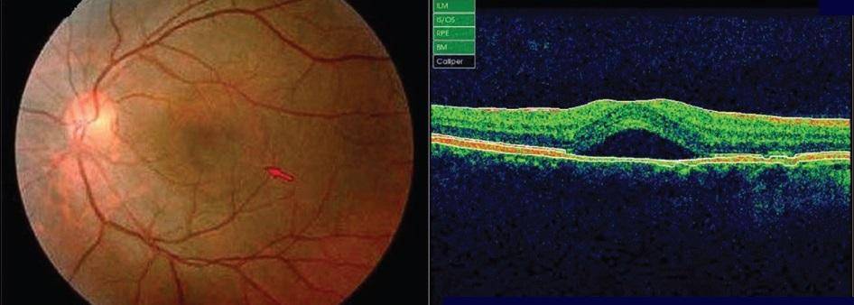 Центральная серозная хориоретинопатия - "здоровое око"