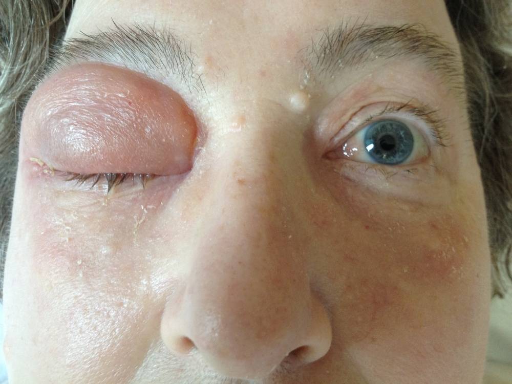 Внутренний ячмень на глазу: как лечить, правильное лечение пораженного внутри века, сложно ли вылечить заболевание