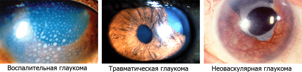 Степени глаукомы: 1, 2, 3 и 4 стадии, чем различаются?