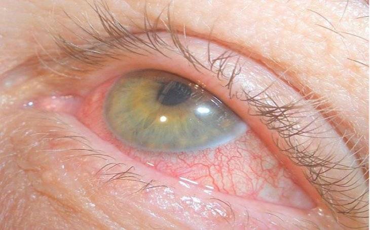 Ирит глаза: симптомы, причины, лечение воспаления радужной оболочки, диагностика, виды, профилактика