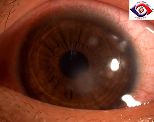 Кератопатия глаза — что это и как лечить