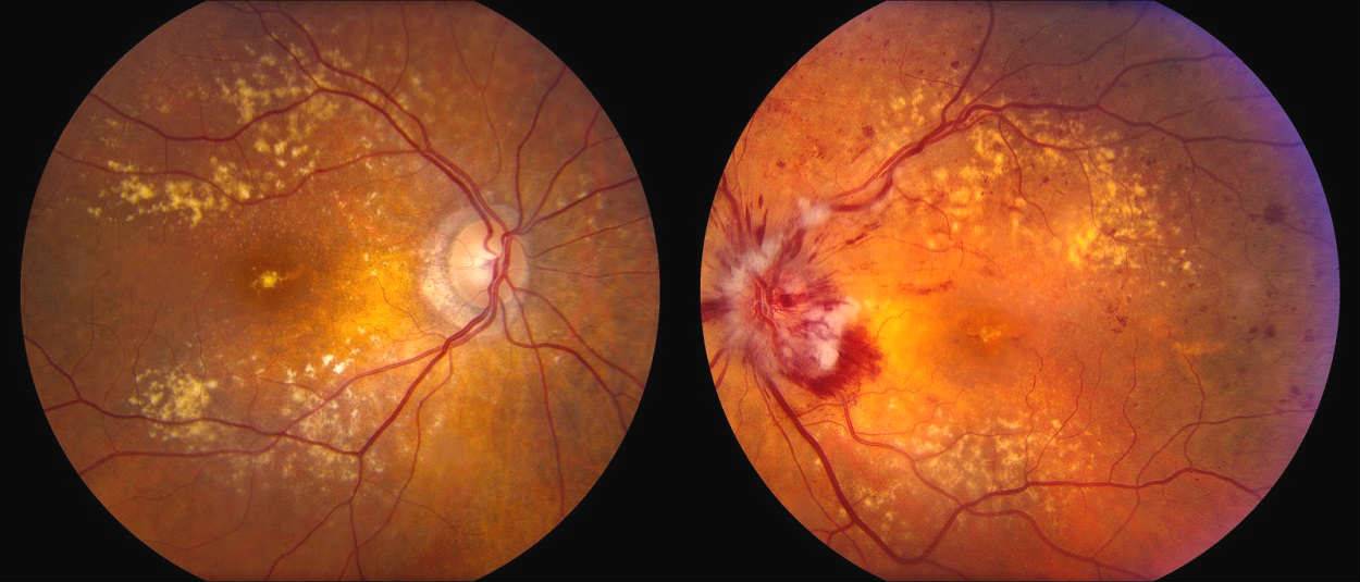 Тромбоз центральной вены сетчатки глаза: лечение и симптомы