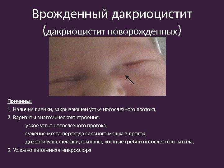 Воспаление слёзного мешка: симптомы, лечение oculistic.ru
воспаление слёзного мешка: симптомы, лечение