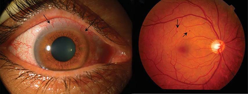 Разрыв сетчатки глаза приводит к отслойке тканей