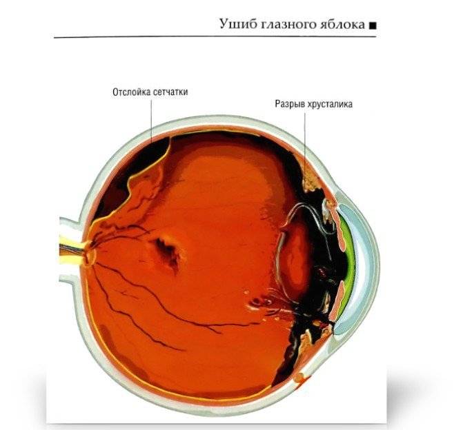 Незамедлительная помощь при ушибе глазного яблока: что делать в первую очередь? диагностика и лечение