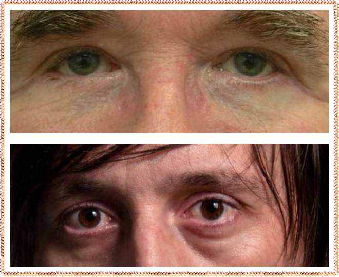 Синяки под глазами у мужчин: основные причины появления