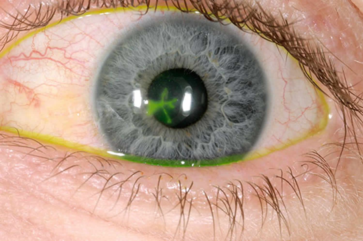 Кератит глаза