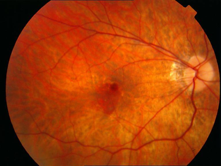 Разновидности, причины макулодистрофии сетчатки глаза, лечение традиционными и народными средствами