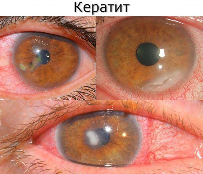 Кератит глаза: причины, симптомы и лечение воспаления роговицы, что это такое (фото)