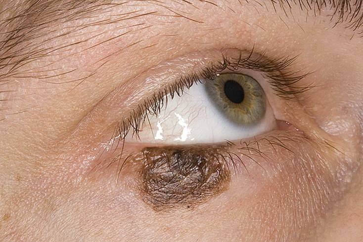 Рак глаза, первые симптомы и признаки опухоли