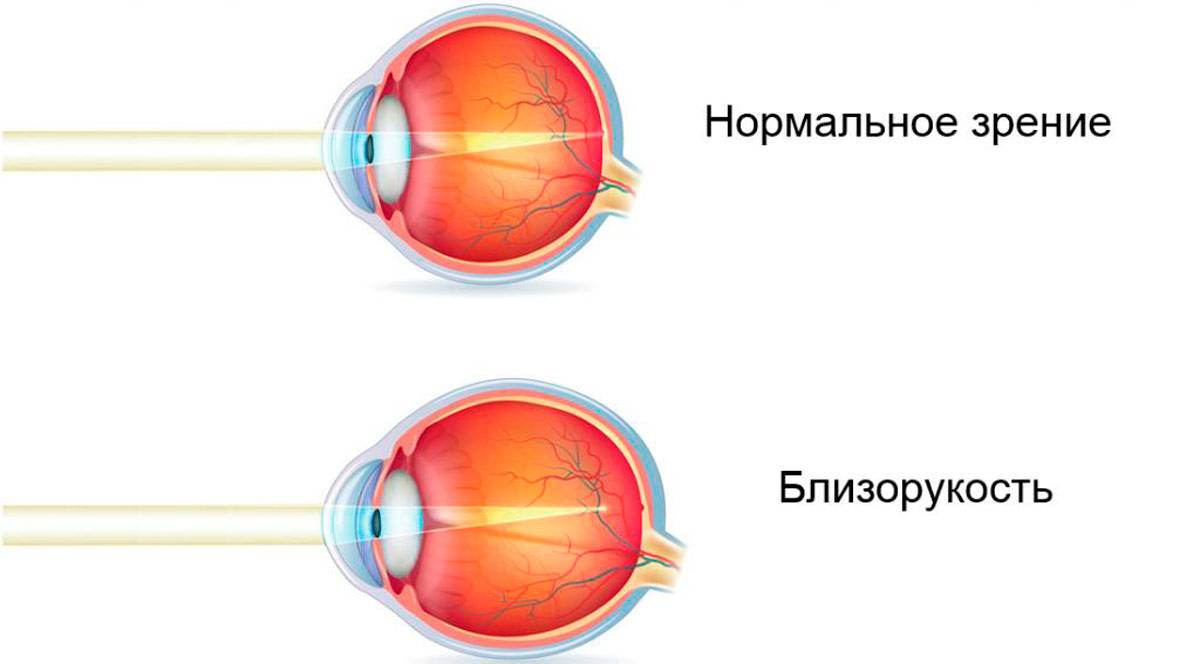 Разное зрение на глазах - как называется, причины