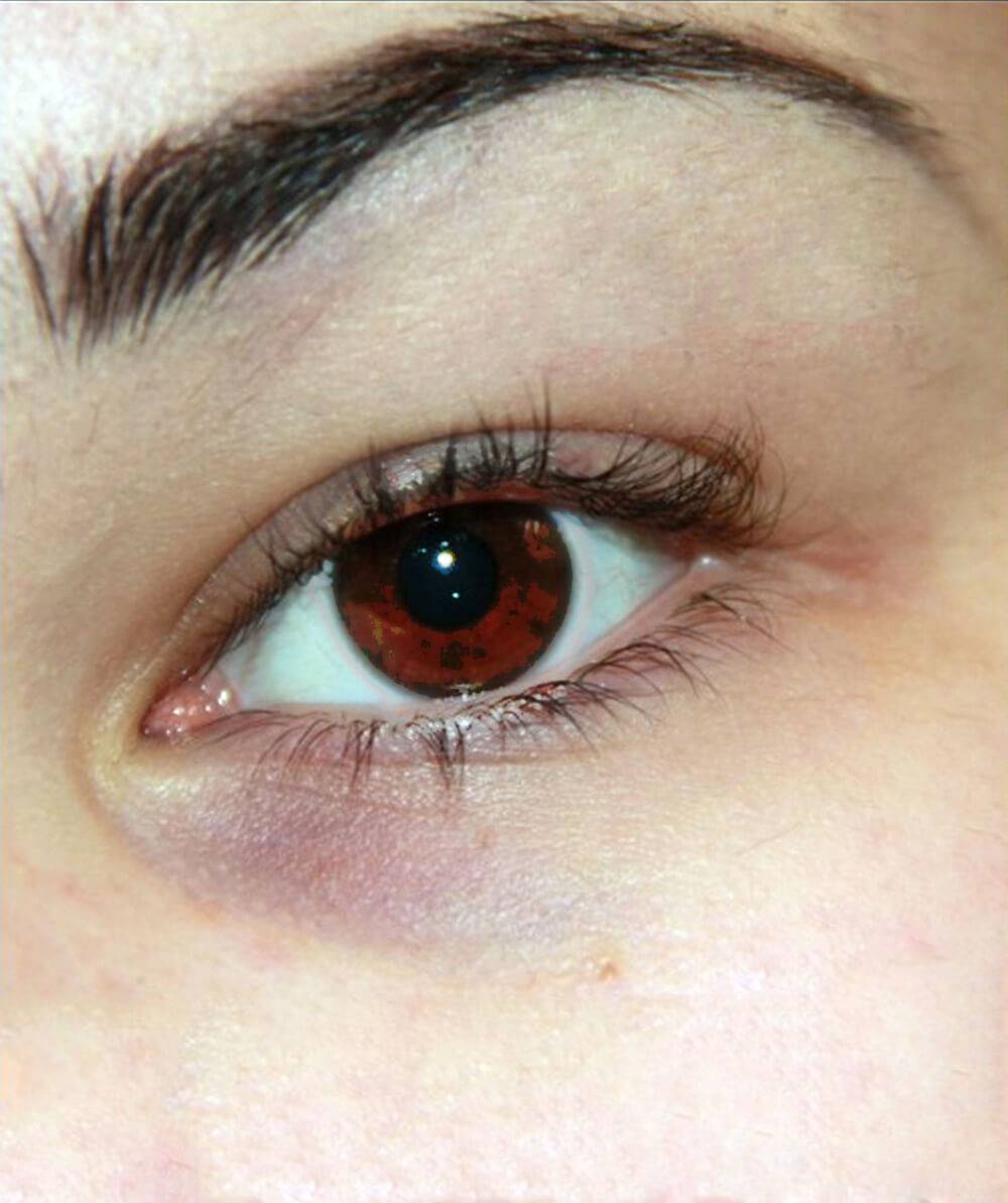 Синяк под глазом без ушиба - причины появления, лечение