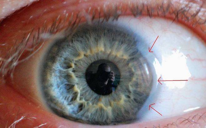 Кератоконус глаза: причины возникновения, симптомы, лечение и профилактика