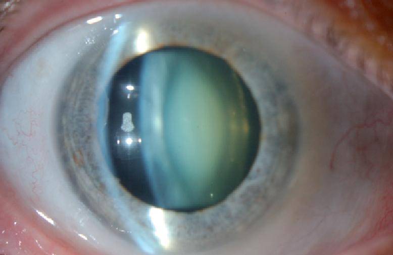 Ядерная катаракта у пожилых людей: что это такое, причины, симптомы различных видов, лечение бурой и старческой форм заболевания, профилактика
