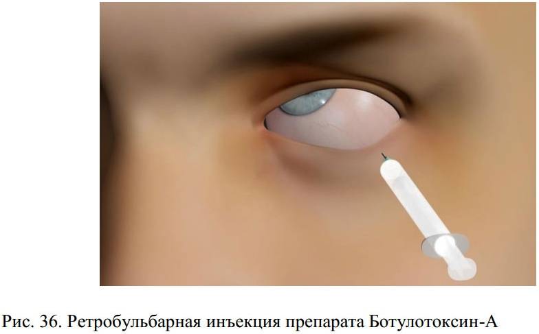 Уколы в глаз - как проводят инъекции в глазное яблоко, виды, препараты