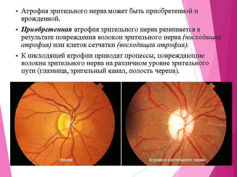 Заболевания зрительного нерва. воспаление, атрофия зрительного нерва и др.