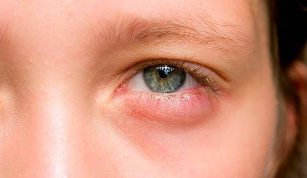 Простуда глаза: понятие, симптомы, лечение - "здоровое око"