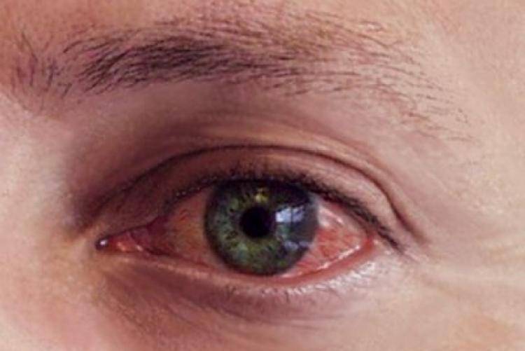 Как поскорее избавиться от неприятных симптомов воспаления глаз? чем лечить коварное заболевание