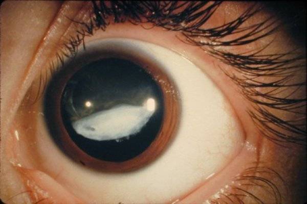 Эндофтальмит и панофтальмит глаза: симптомы, способы лечения