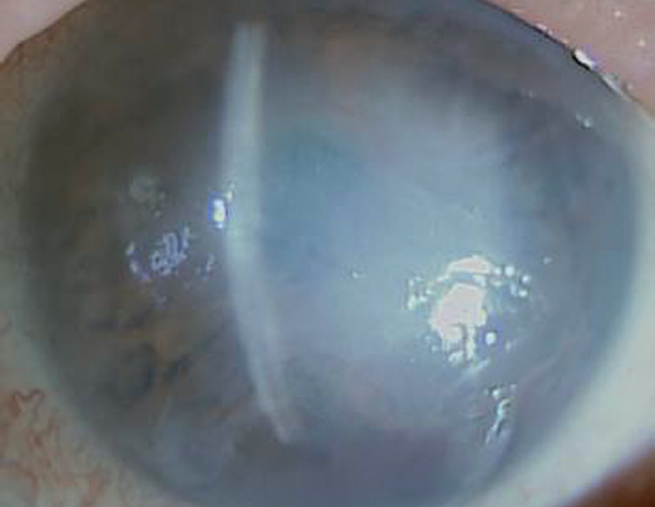 Что вызывает дистрофию роговицы глаза, как проходит лечение