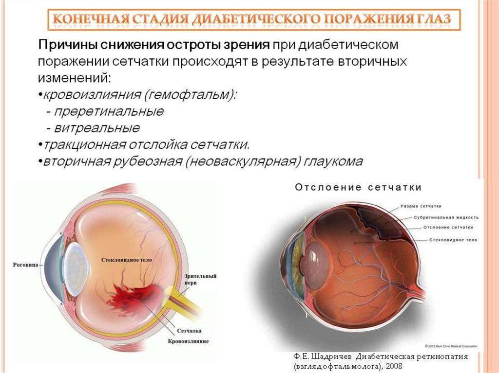 Диабетическая ретинопатия: симптомы, лечение, классификации