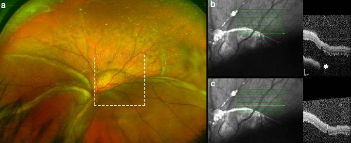 Что такое ретиношизис сетчатки, как остановить прогрессирование и вылечить болезнь