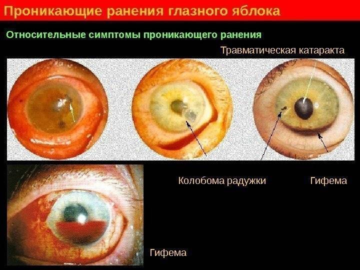 Последствия контузии глаза и методики их лечения
