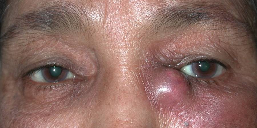 Воспаление глаза - виды, симптомы, лечение