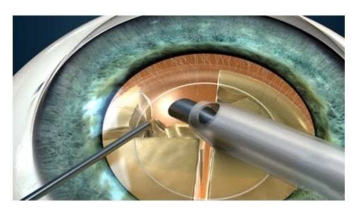 Замена хрусталика глаза: операция, цены, отзывы, при катаракте