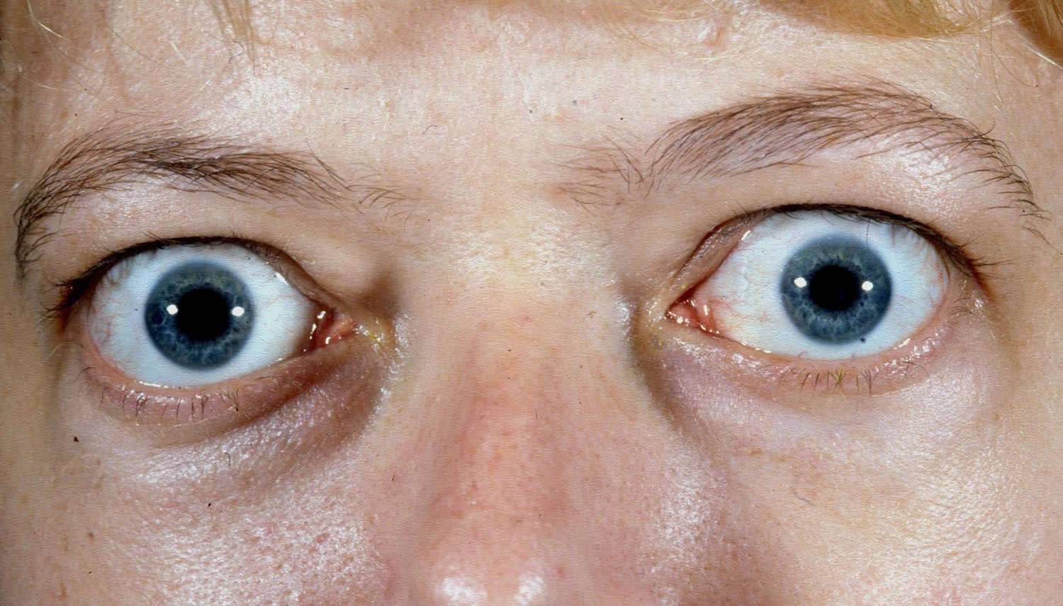 Симптоматика, виды и лечение миопатии глаз