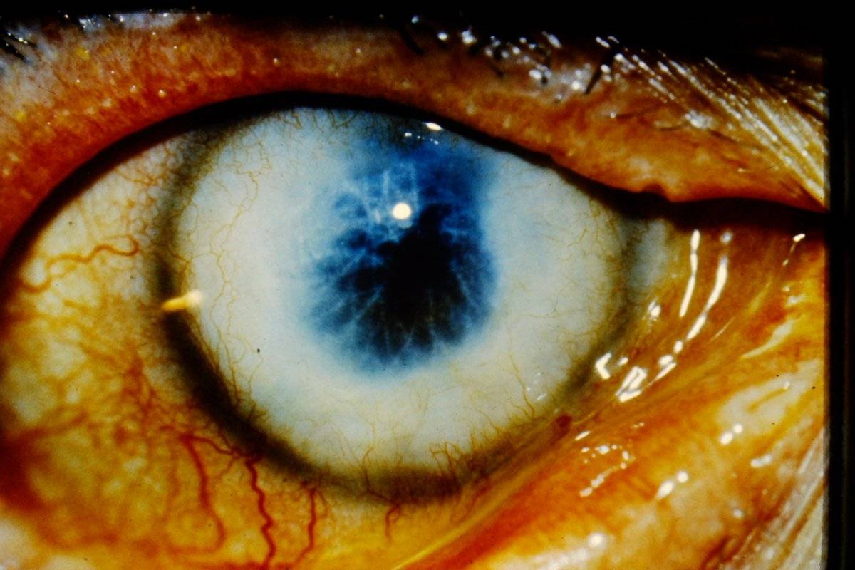 Кератопатия глаза