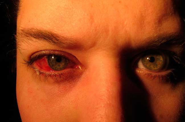 Кровь из глаз - фото, причины, лечение, что делать